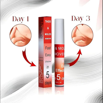 Tags & Mole remover (Buy 1 Get 1 Free )